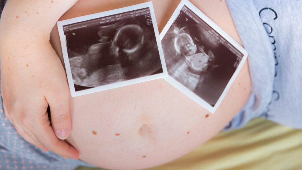 Quel médicament choisir pour augmenter ses chances d’avoir des jumeaux ?