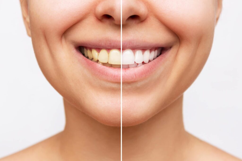 Quel est le meilleur remède de grand-mère pour des dents plus blanches ?