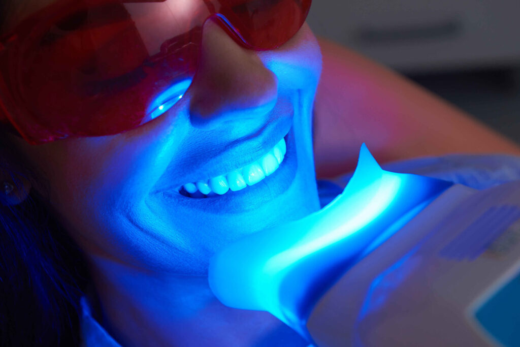Obtenez un sourire éclatant avec un kit de blanchiment dentaire en parapharmacie